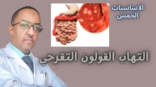 التهاب القولون التقرحي - ماهو الدواء الحل