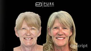 All-On-4 Dental Implants In A Day Patient Testimonial | Pure Dental Health | Atlanta, Dunwoody, GA