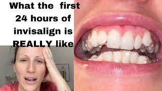 My first 24 hours with Invisalign braces 2020