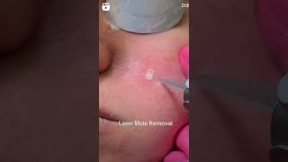 Laser mole removal treatment#lasermoleremoval#skincare#laserskincare#laserskinrejuvenation#beauty