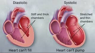 Congestive Heart Failure (CHF): An Introduction