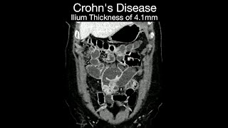 Crohn's Disease