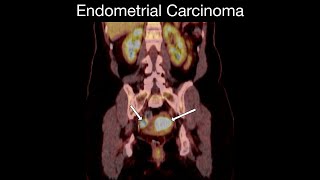 Endometrial Carcinoma