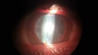 Blue dots Cataract. Ophthalmology