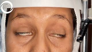 Ophthalmic Signs Eyelids