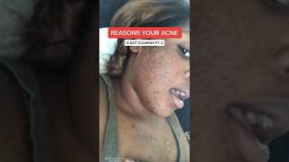 Reason why your acne is NOT clearing part 2 #acneproneskin #acnetransformation #blackgirlwithacne