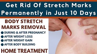 Stretch Marks Removal Home Remedies | Permanently Resolve Stretch Marks Problem Healthcare Remedy