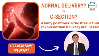 What baby positions are favorable for normal delivery ?