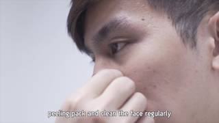 ACNOC: How to use Acneser Spot Gel for Small pimples