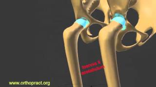 hip dysplasia  developmental dislocation of the hip toennis 2