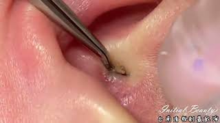 Ear Blackhead professional extraction - Full Video of blackhead removal on ear