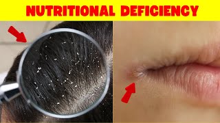 13 ALARMING Signs That Indicate You Have A Nutritional Deficiency