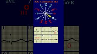 ЭКГ. Изменения QRS при изменении ЭОС. #shorts