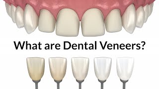 Best place to get veneers in Mexico in 2023-Sani Dental Group