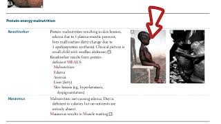 df bw kawashior and marasmus page 71| first aid USMLE|fcps question bank