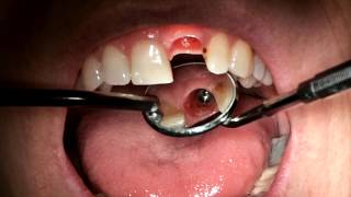 Central Incisor Implant Impression