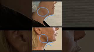 The Next Level Neck procedure achieves dramatic neck rejuvenation without long scars or downtime.