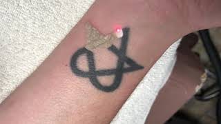 Laser tattoo removal on black wrist tattoo