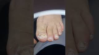 Grzybica paznokci TOENAIL FUNGUS treatment