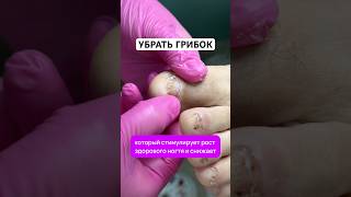 Эффективное средство от грибка ногтей. Артикул - 67774905 🌹 #грибокногтей