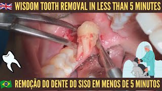 Wisdom tooth removal in less than 5 minutes - Remoção do dente do siso em menos de 5 minutos