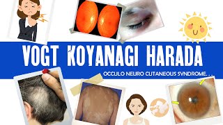 Vogt Koyanagi Harada syndrome | VKH | granulomatous uveitis | ophthalmology