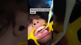 👩‍⚕️✨ Braces Aren’t Just for Kids! ✨👨‍⚕️ #shorts #dentistry #youtubeshorts