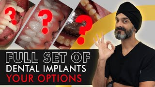 OPTIONS WITH A FULL SET OF DENTAL IMPLANTS - What You Need to Know