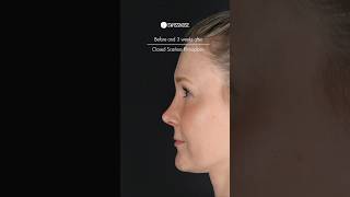 Before and 3 weeks after Closed Scarless Rhinoplasty | Dr. med. Simon Zimmermann