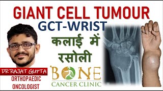 Giant Cell Tumour GCT Wrist Distal radius Hindi कलाई की हड्डी में रसोली का सफल ईलाज GCT IS CURABLE