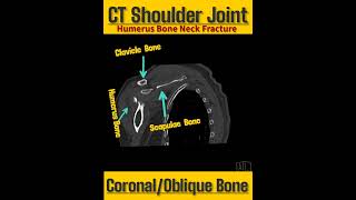 #radiology  shorts / CT Shoulder Joint /Coronal /Oblique Bone  MPR....