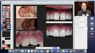 Frenectomy. Education for dental staff.