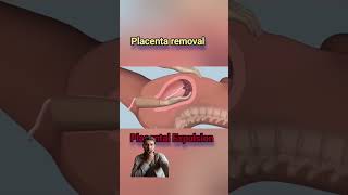 #placenta Explution #placentaemoval