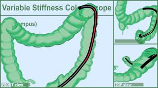 COLONSCOPY: Segment by Segment (10/03)