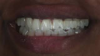 DDA Aligners Case