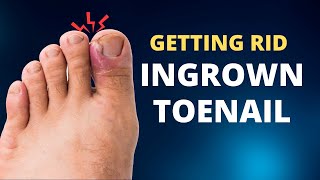 Ingrown Toenail  | 4 Easy Steps for Getting Rid