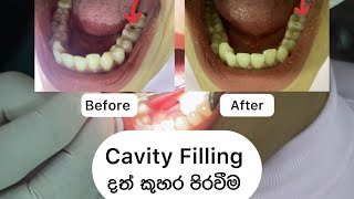 Cavity Filling දත් කුහර පිරවීම Britanna Dental Clinic