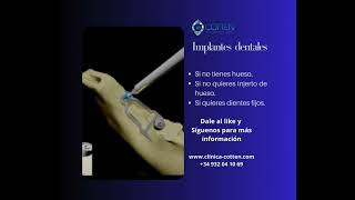 IMPLANTES DENTALES