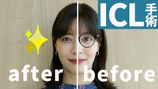 【体験談】ICL手術に失敗しないために専門医に相談してみた【教えてドクター】