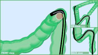 SPLENIC INTUBATION - Push Tecnique: Standard Colonscope