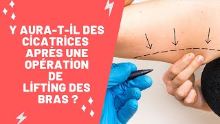 Y aura-t-il des Cicatrices Après une Opération de Lifting des Bras ?