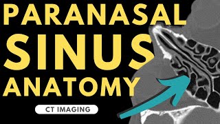 Paranasal Sinuses and Nasal Cavity | Radiology anatomy part 1 prep | CT imaging