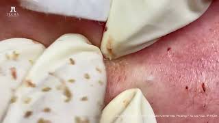 Big Cystic Acne Blackheads Extraction Blackheads & Milia, Whiteheads Removal Pimple Popping