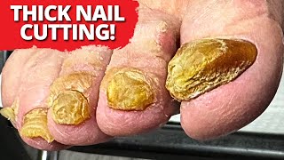 Cutting Thick Yellow Toenails – You Won’t Believe the Before and After!