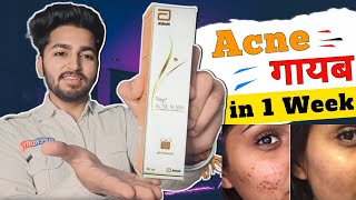 Acne हटाओ सिर्फ 1 Week मे | Acne Wash Foaming Face Wash Benifits