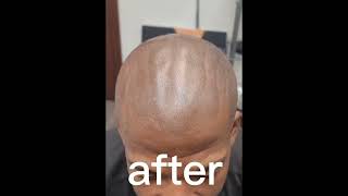 SMP 2 nd Session Scalp Micropigmentation by Antonio Baroque