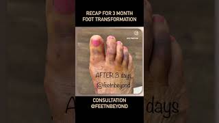 3MONTH RECAP  TRANSFORMATION OF PAINFUL BUNION AND HAMMERTOES ✨