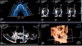 Cone beam TC Cranio 3D.avi