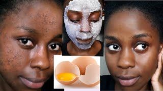 Kuondoa CHUNUSI Usoni na MAKOVU kwa haraka | How to get rid of acne