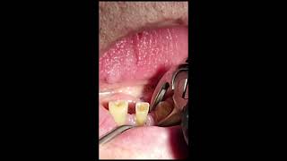 teeth extraction